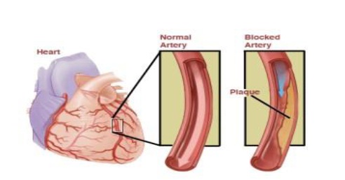 Angina Pectoris